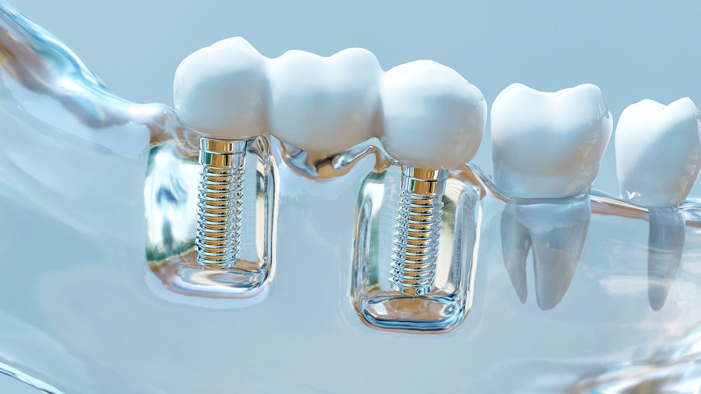 multiple implants