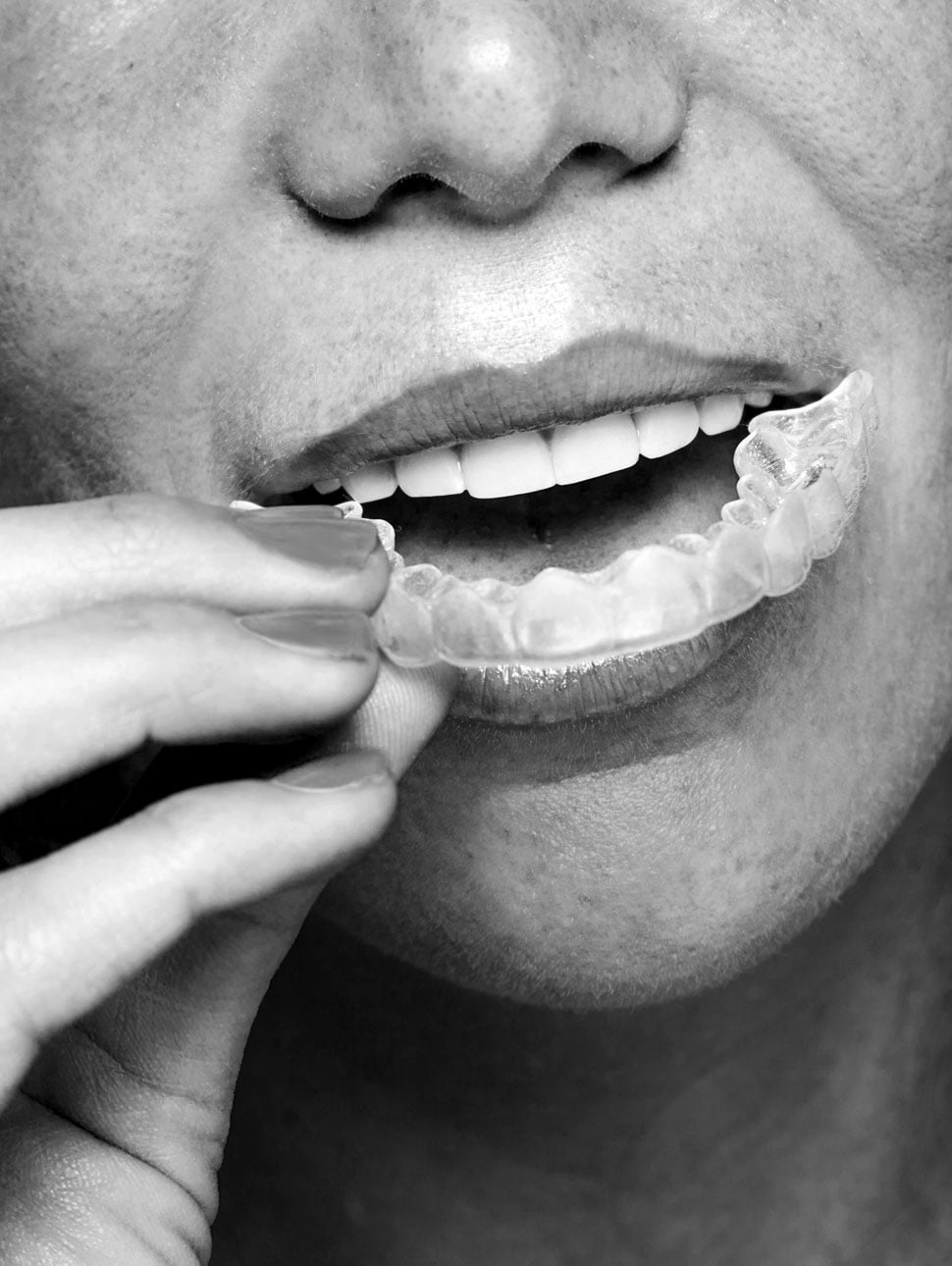 http://Aligners