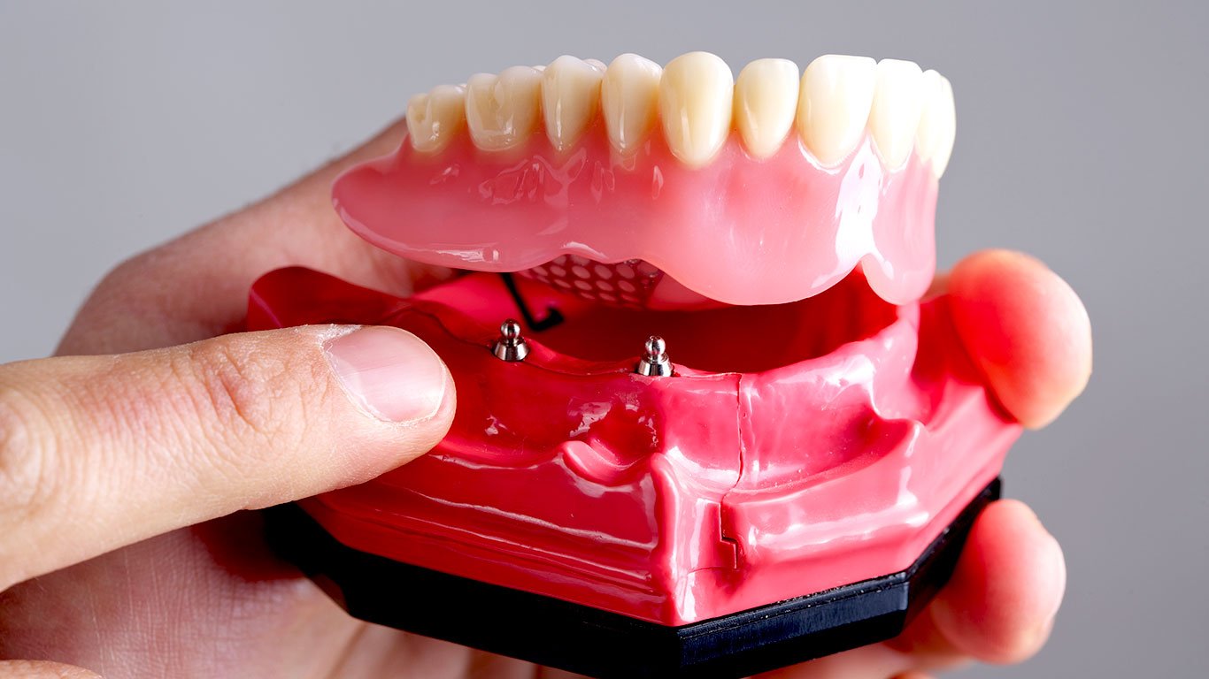 Implant retained dentures