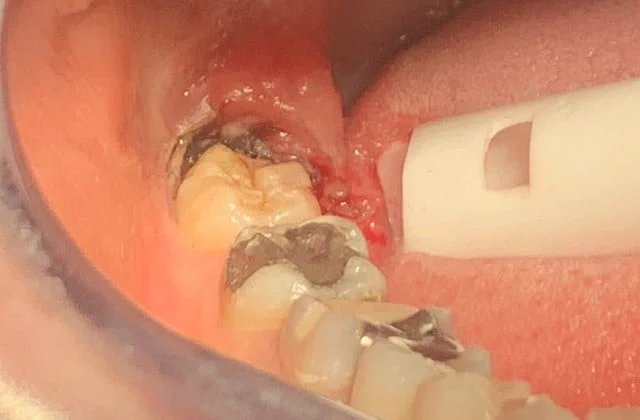 Toothache Pain and Antibiotics - What are my options? | Dentist Isle of Man
