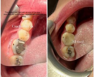 Blog - Cracked Teeth - 1 - Tracey Bell