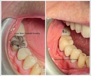 Blog - Cracked Teeth - 2 - Tracey Bell