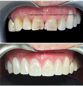 Blog - Cracked Teeth - 3 - Tracey Bell