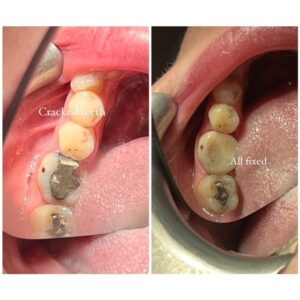 Blog - Cracked Teeth - 4 - Tracey Bell