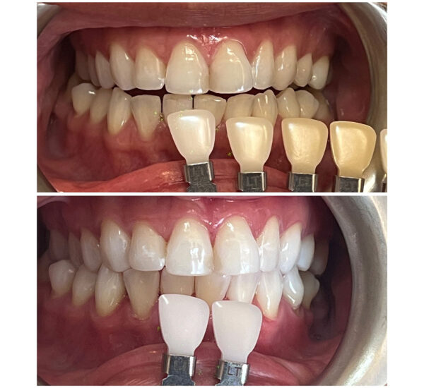Yellow Teeth - Causes and Teeth Whitening Options