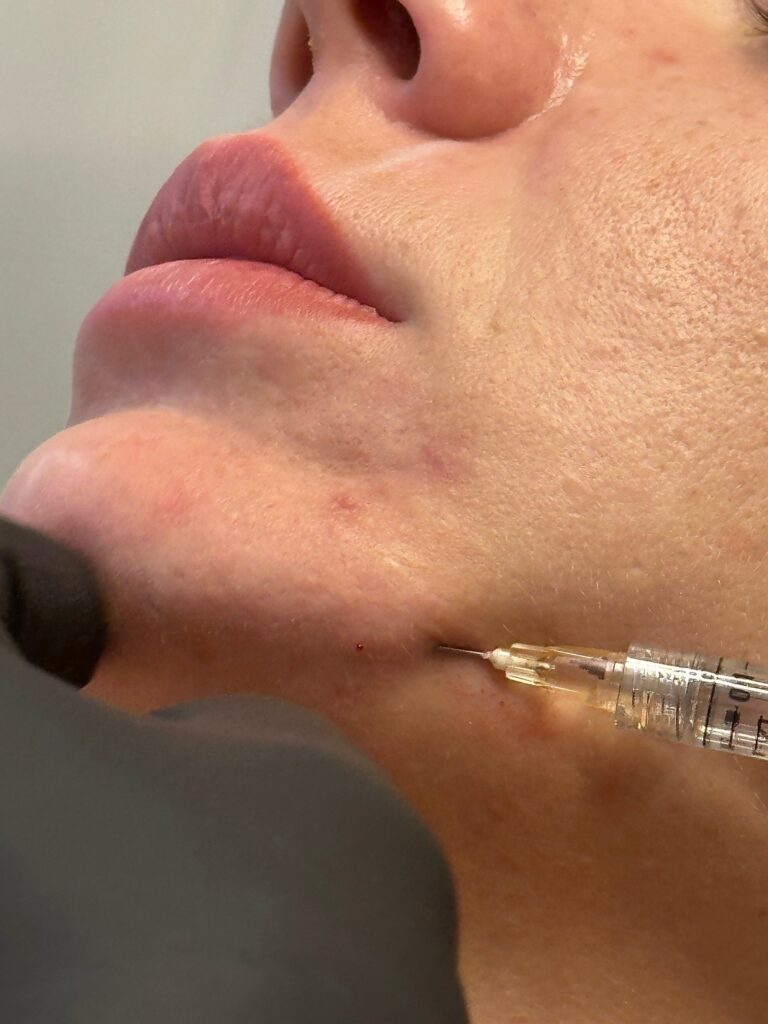 Defining a Jawline - Blog Photo 3