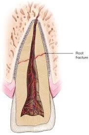 Root fracture
