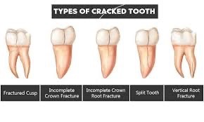 Types of root fracture