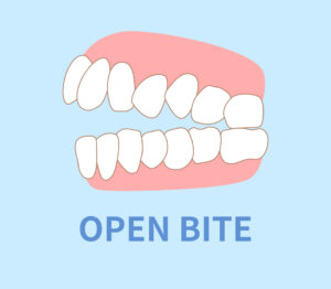 open bite