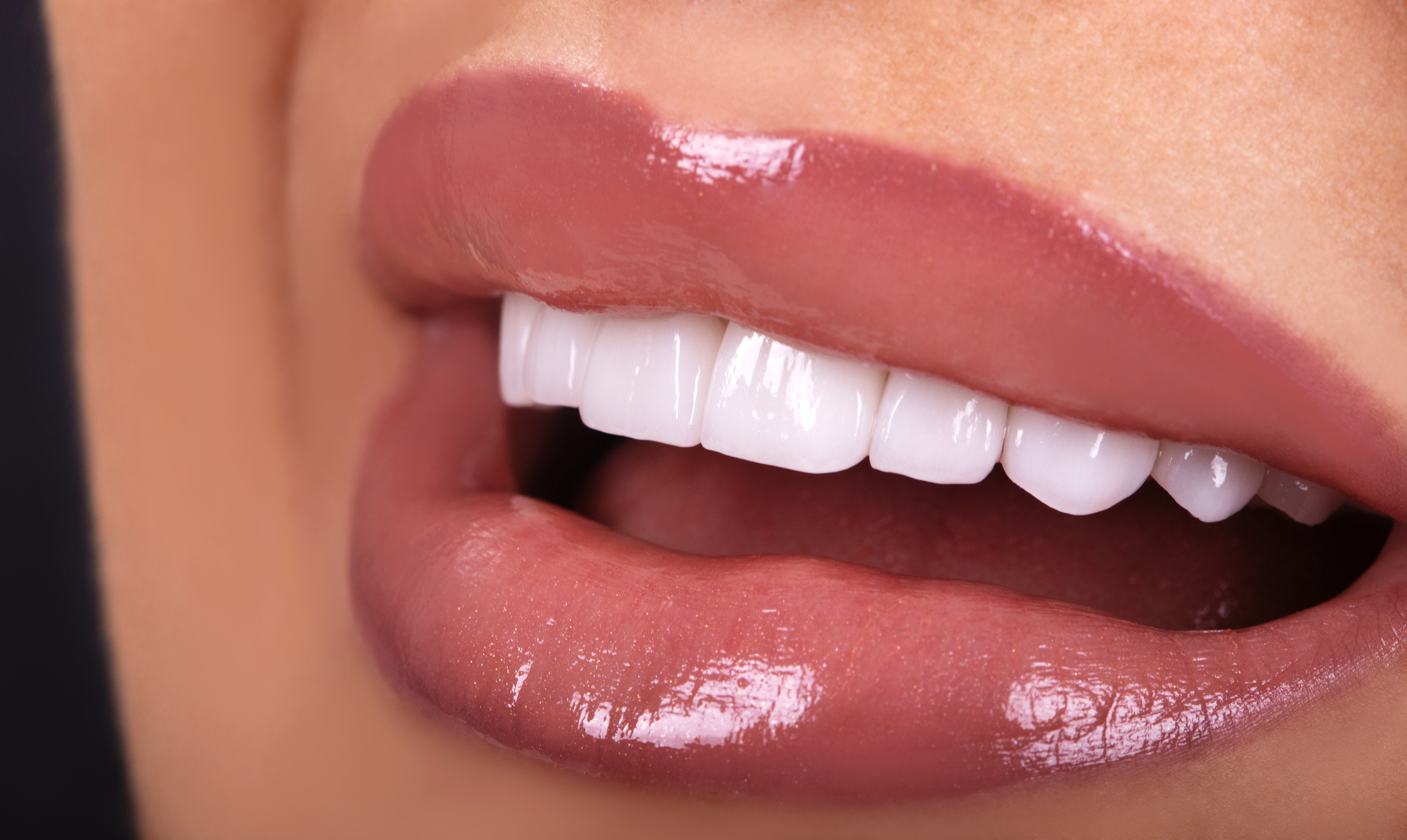 Gloss veneer smile