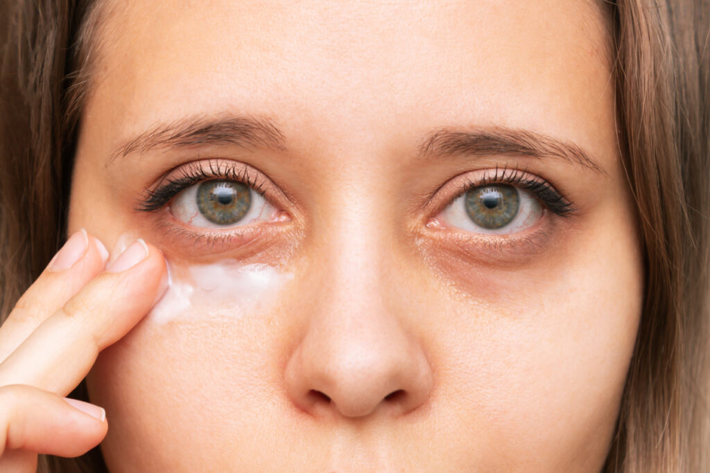 dark eye bags