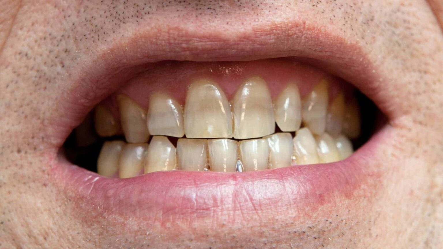 Why Teeth Turn Black Causes and Prevention Dentist Isle Of Man