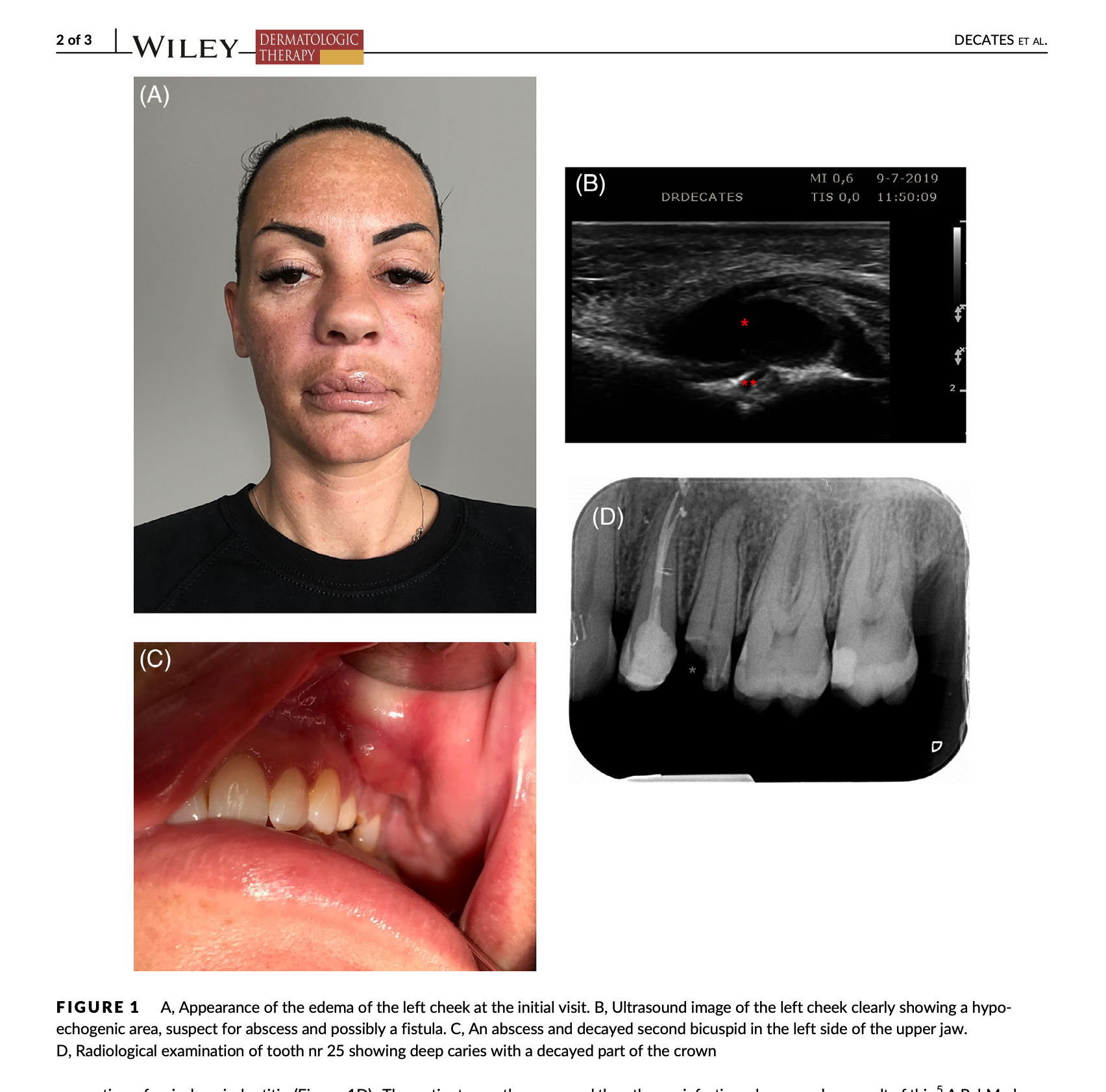 show oedema of eyes foollowing tear trough filler
